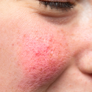 Erythema