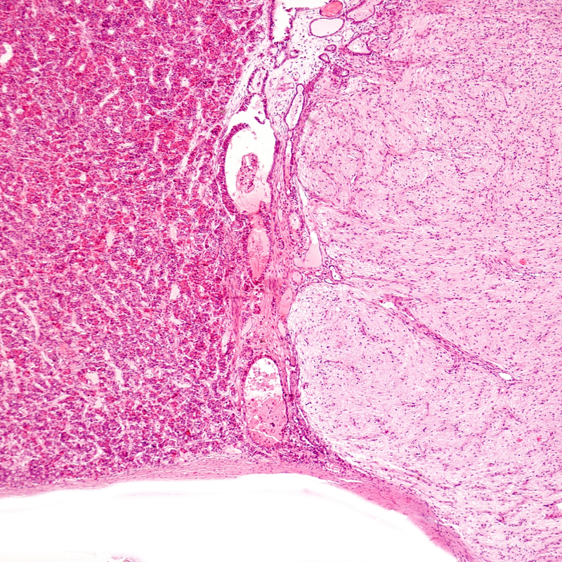 Rathke Pouch Tumour
