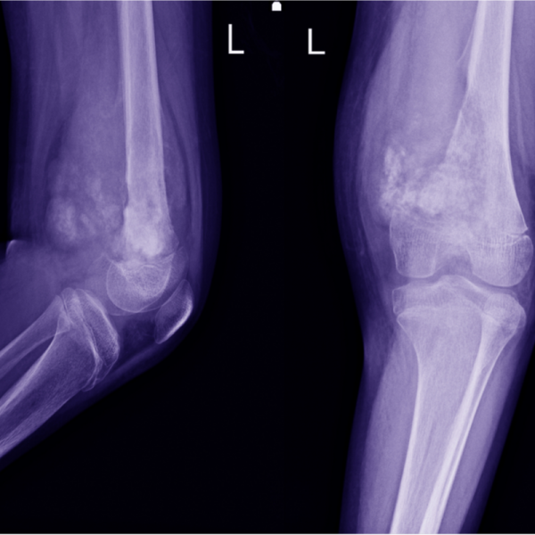 Osteosarkoma