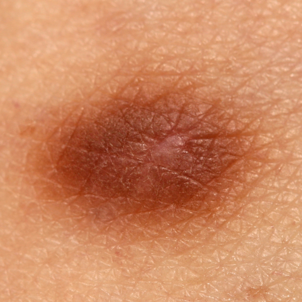 Histiocytoma