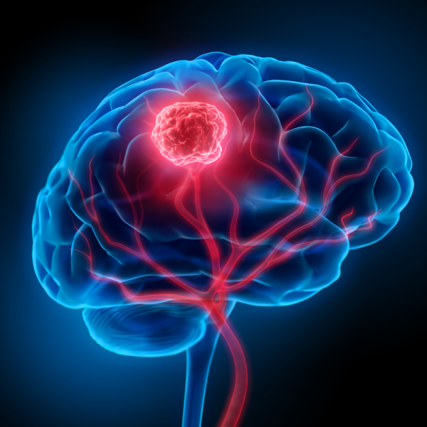 Brain tumour bening