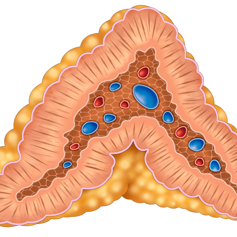 Phaeochromocytoma