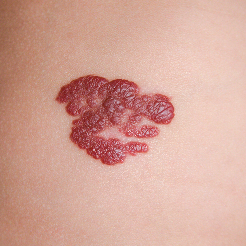 Hemangioma