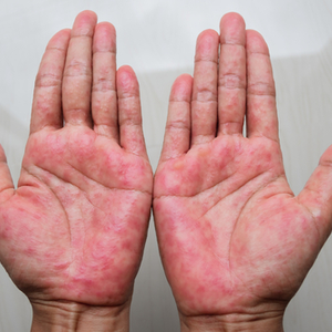 Dermatitida