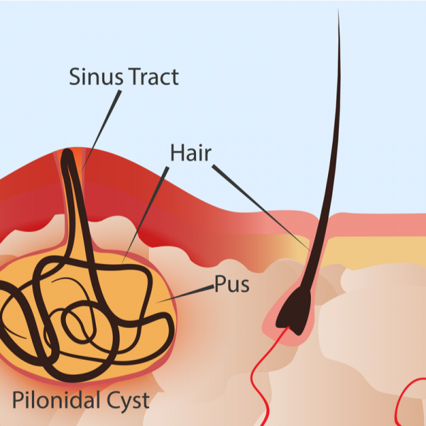 Cisto pilonidal