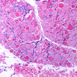 Muskeldystrophie Duchenne