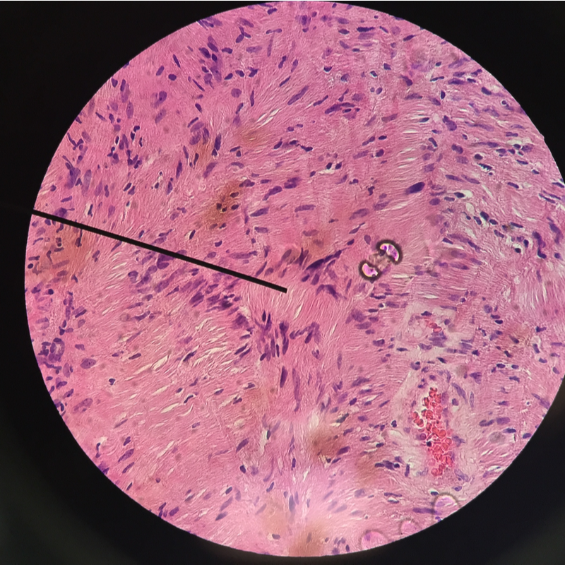 Neurilemmoma