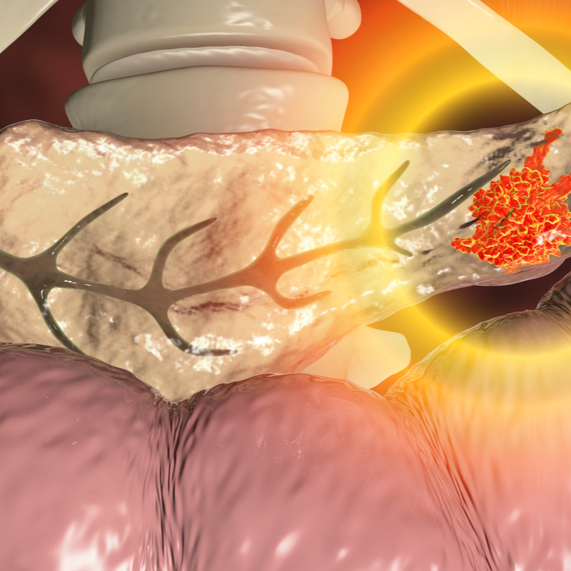Insulinoma