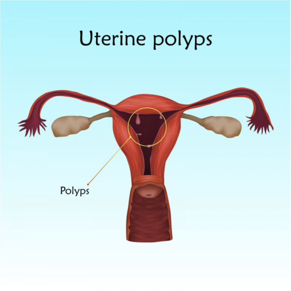 Děložní polyp