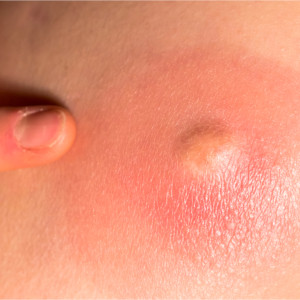 Absces