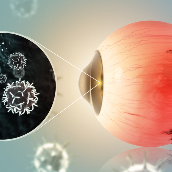 Eye cancer