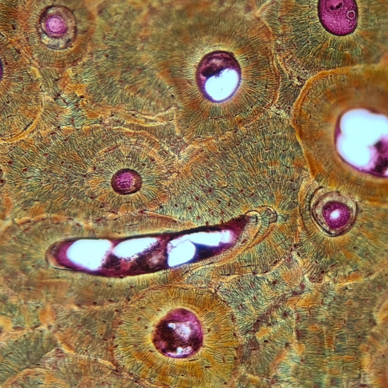 Enchondromatosis