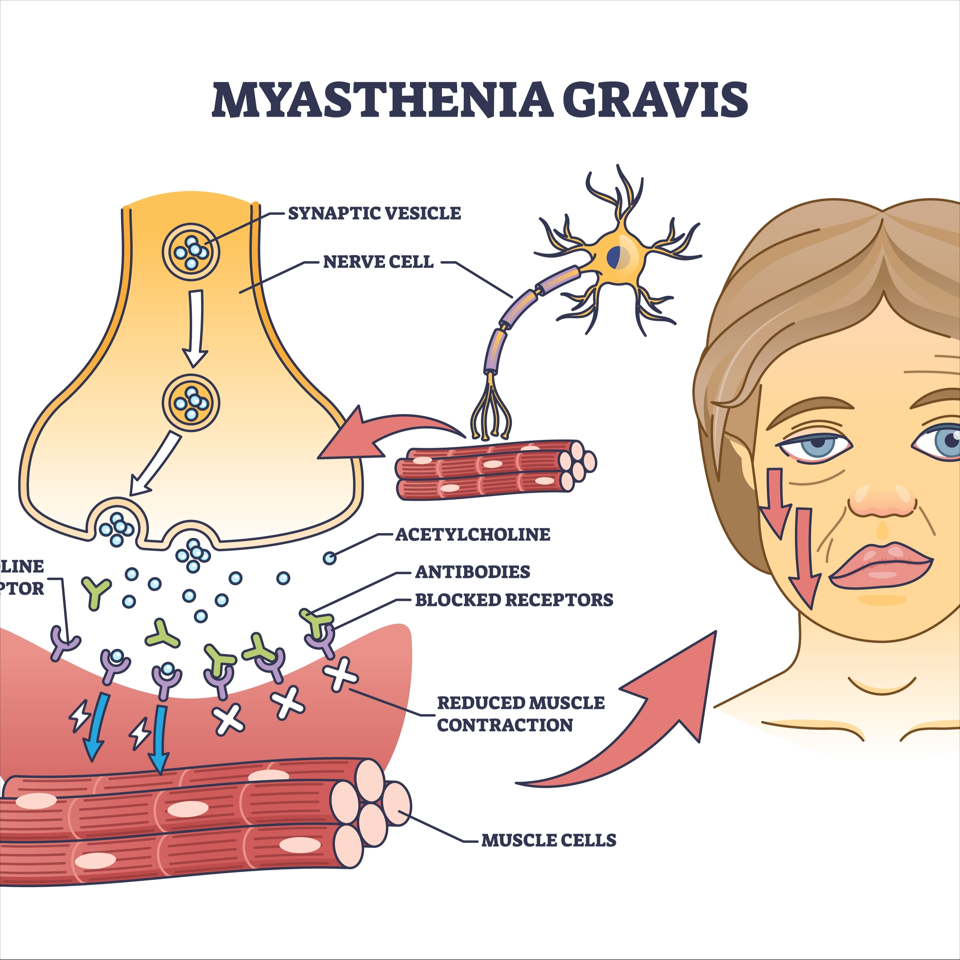 Myasthenia Gravis