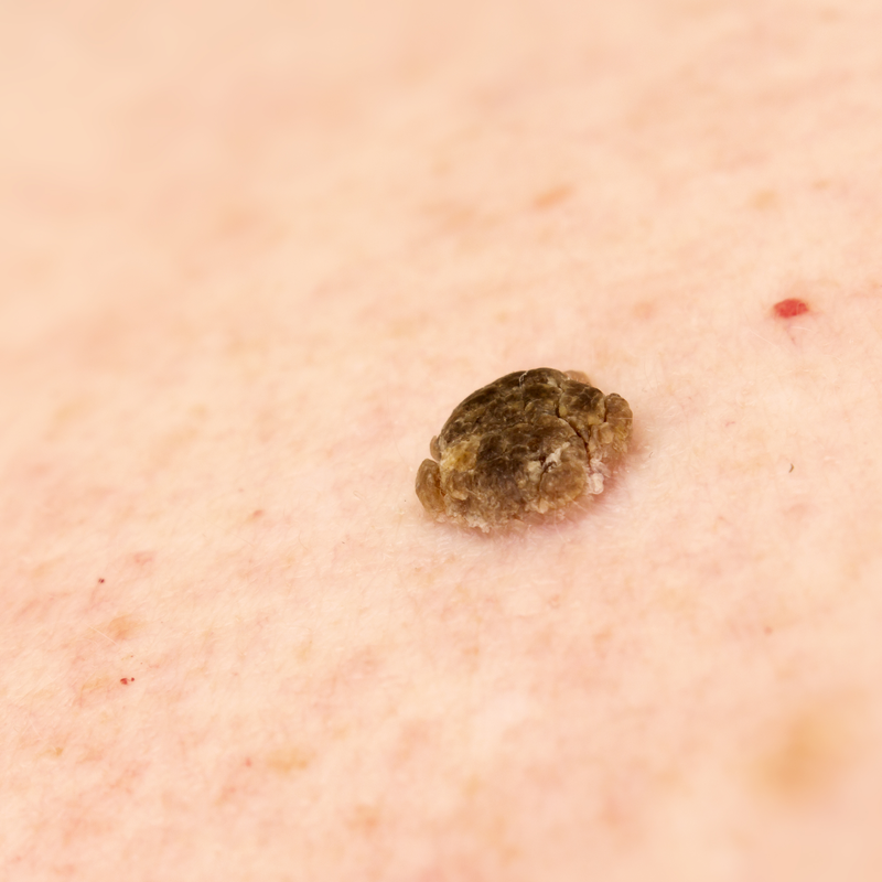 Seborrhoeic keratosis