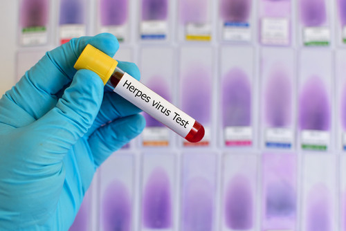 Herpes Simplex Viren