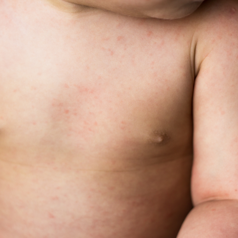 Esantema Subitum Frequenz therapie