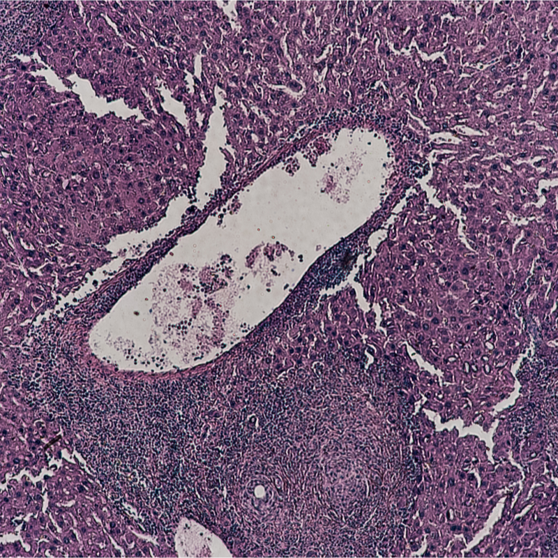 Granolumatoid inflammation