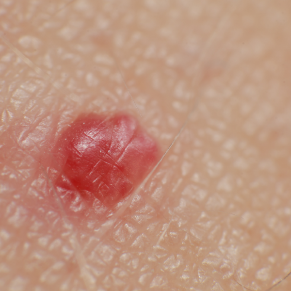 Angioma