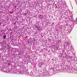 Endometrija karcinoma