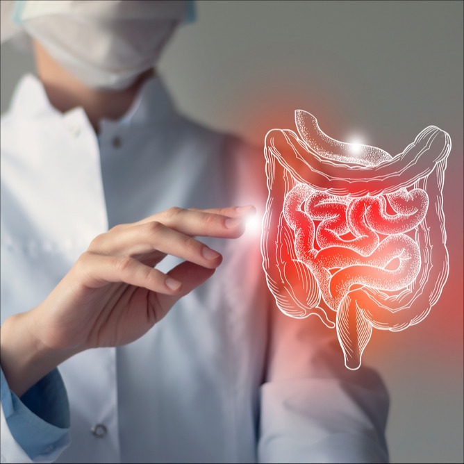 Colitis ulcerosa