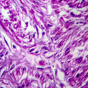 Myom und Frequenztherapie