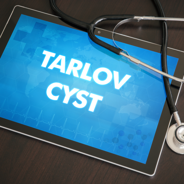 Quisto de Tarlov