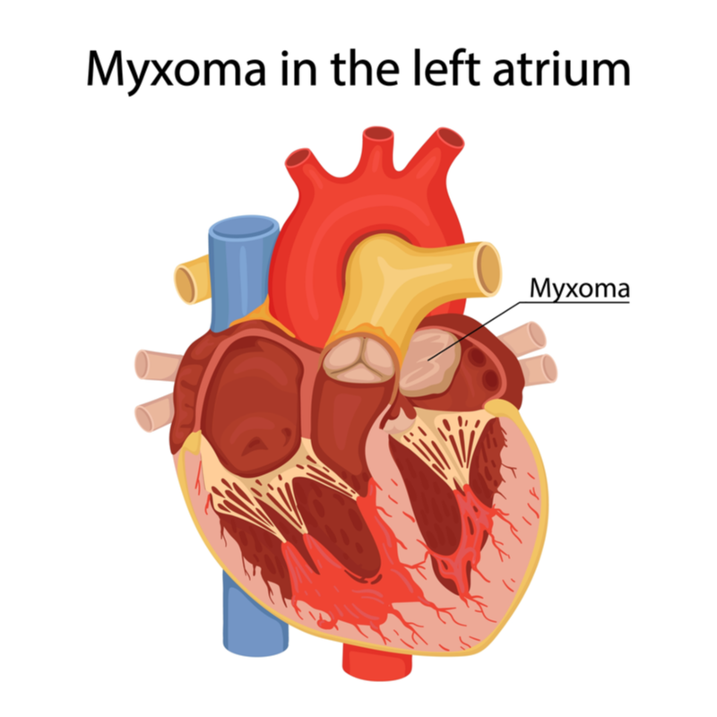 Myxoma