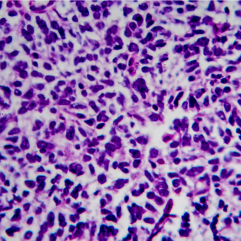 Nefroblastoma