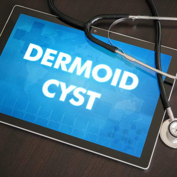 Cisto dermoide