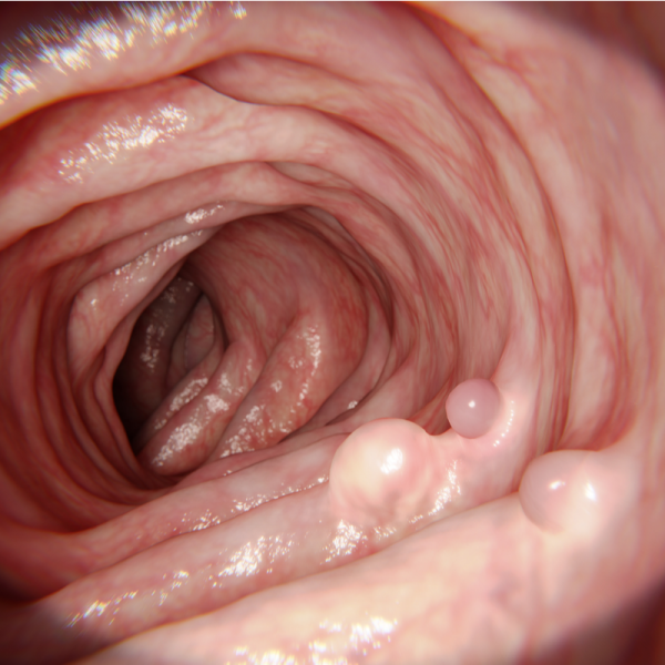 Gardner syndrome