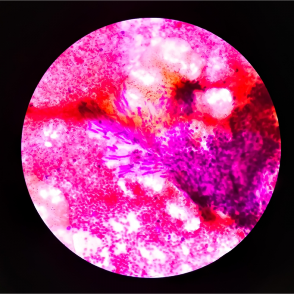 adenom-frequenz-therapie