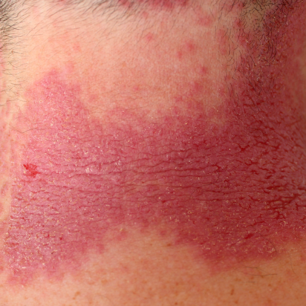 Malattia di Darier | frequenz-therapie.com